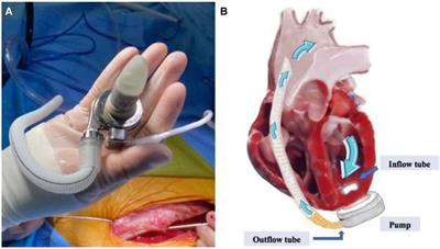 Discovery of delayed gas production after implantation of a continuous-flow left ventricular assist device and a preliminary exploration of the mechanisms of its occurrence